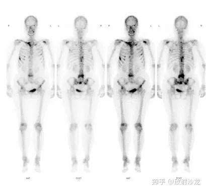 癌症火化骨頭|ZH 